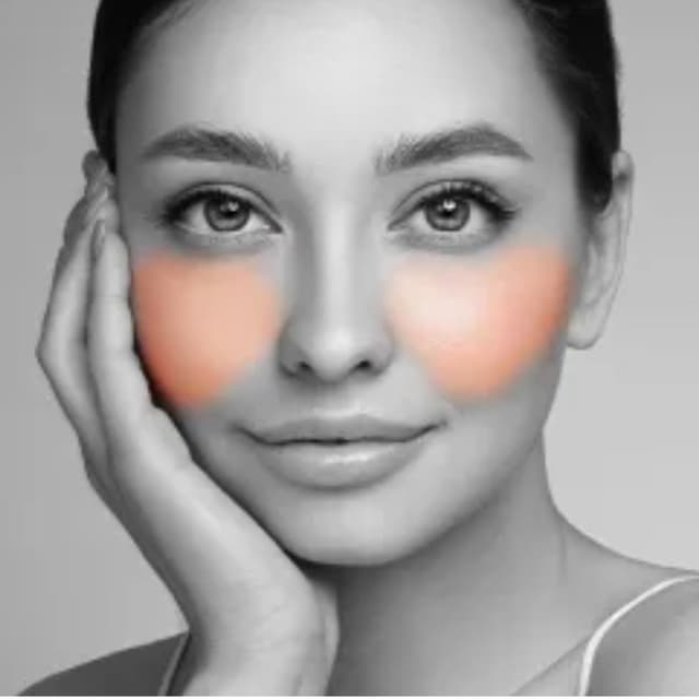 Cheeks-6 Sessions at Eclectic Aesthetics in White Plains, NY